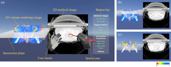 20230521-星空体育医学院博士生张楠、杨讷与李阳曦在中国生物医学工程大会暨创新医疗峰会上获奖-张楠-基于三维空间交互的宫颈癌靶区勾画虚拟现实环境总览.jpg